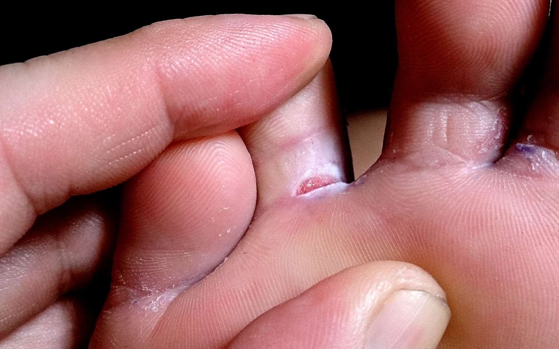 Intertrigo Du Pied Recommandations Mycoses Cutan omuqueuses NHAJR